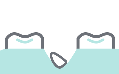 残根からの立ち上げ